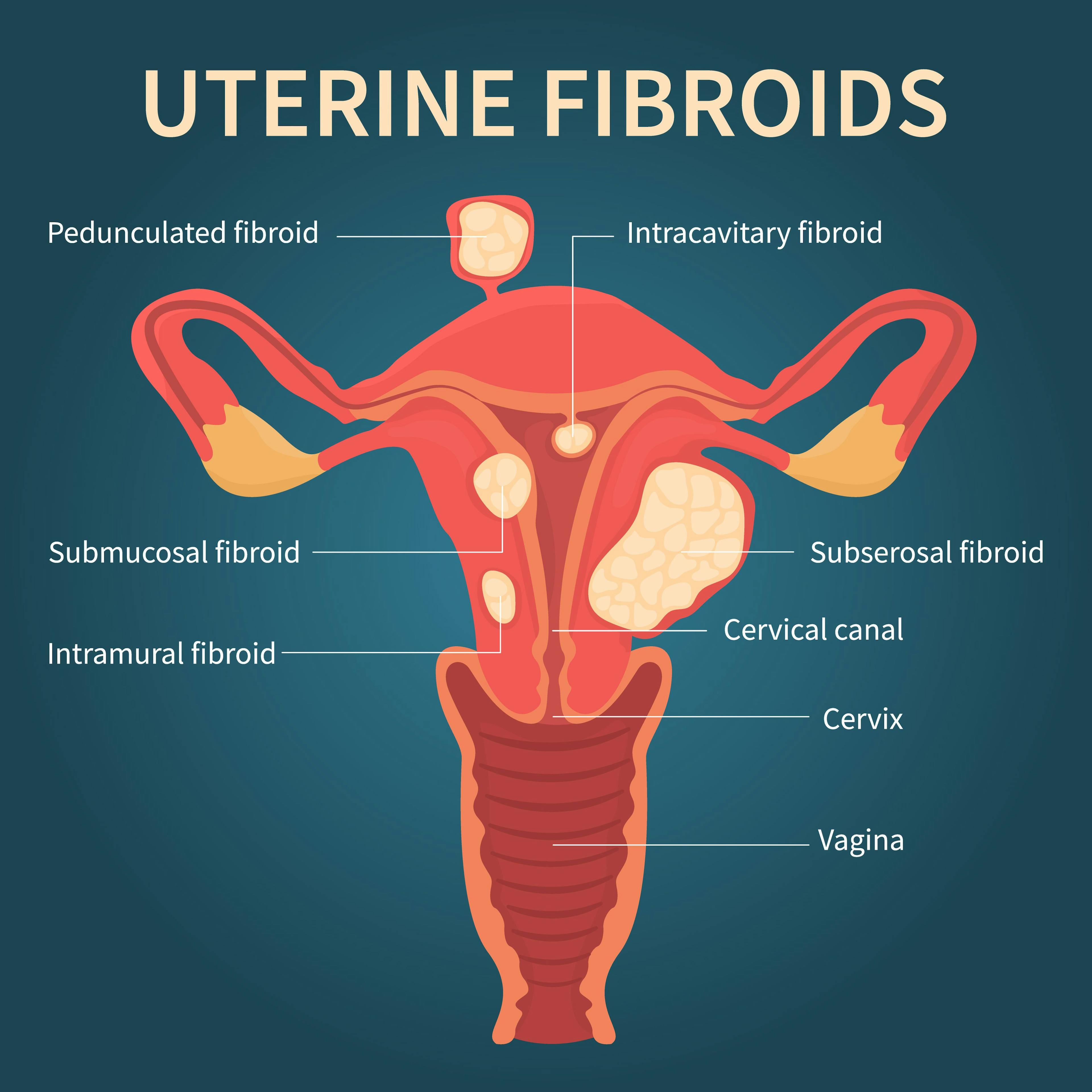 Uterine artery embolization or myomectomy for uterine fibroids