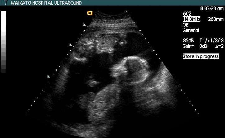SAG Uterus, Twin Gestation Stuck Twin Syndrome in TTTS