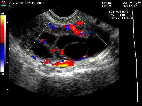 Ovary (Transvaginal) Ovarian Hyperstimulation