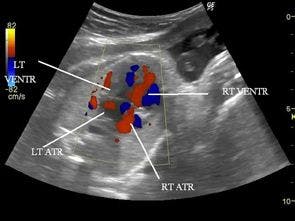 Daily Dx: Fetal Heart Anomaly