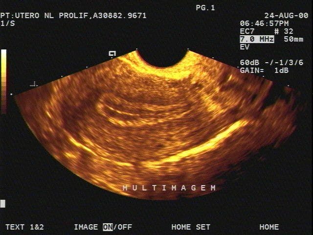 SAG Uterus (Transvaginal) Normal Proliferative Endometrium