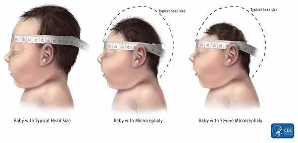 Congenital cytomegalovirus may be leading cause of microcephaly