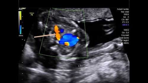 Image IQ: Vascular Anomaly in Fetus