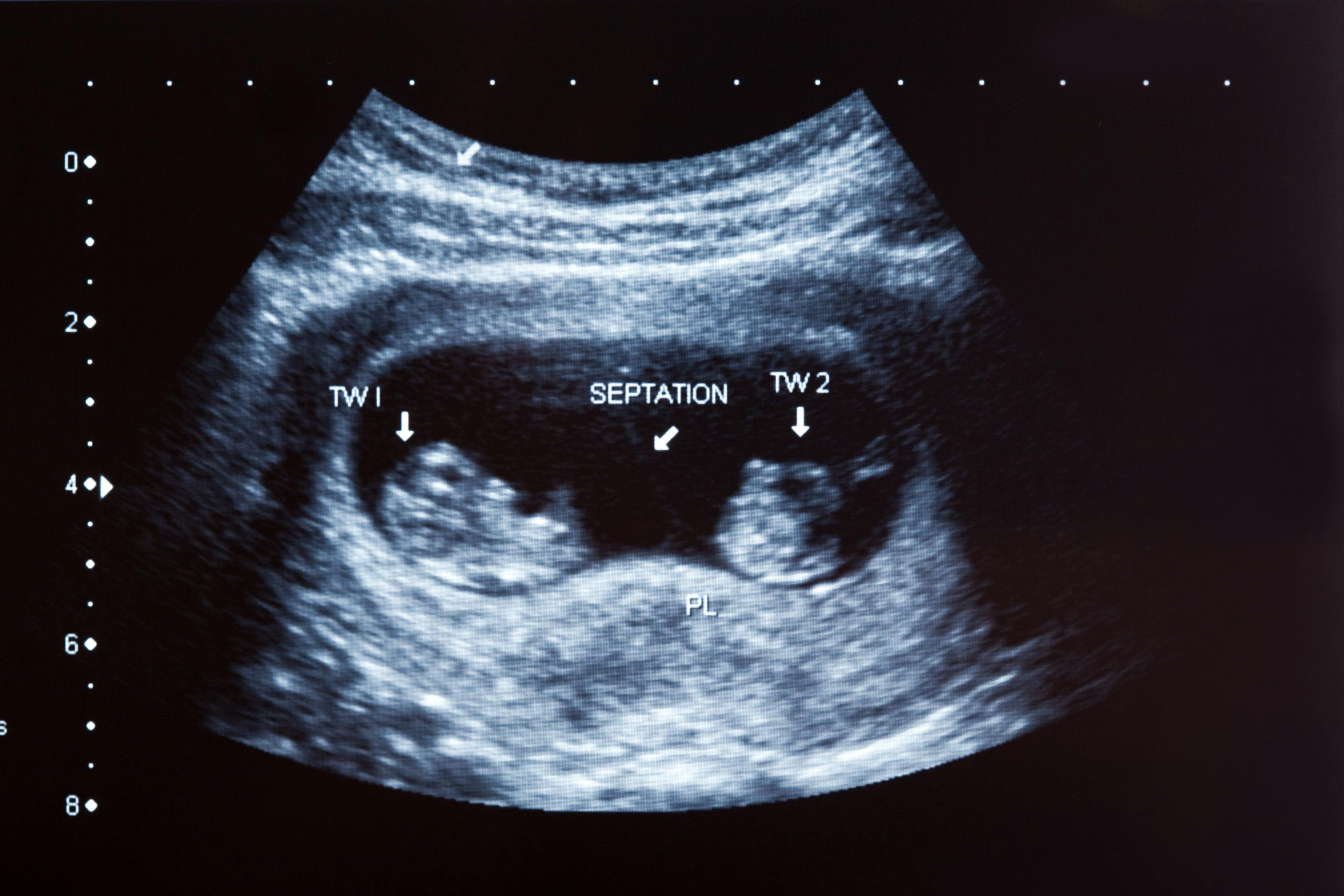 Reducing multifetal pregnancy through publicly funded IVF programs | Image Credit: © Martin Valigursky - © Martin Valigursky - stock.adobe.com.