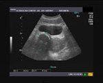 DailyDx: What is the Diagnosis of this Ultrasound Image?