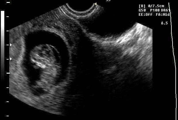 LONG Fetus Increased NT in T13 Fetus