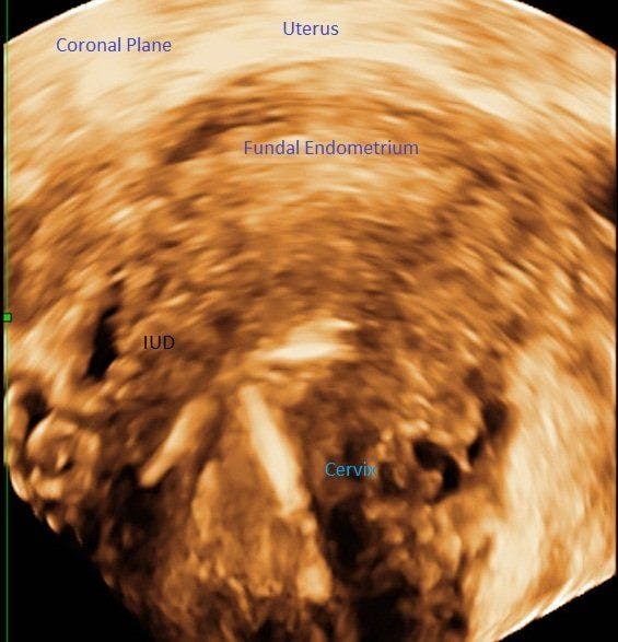 Coronal Plane and 3D Imaging Key for IUD Complications